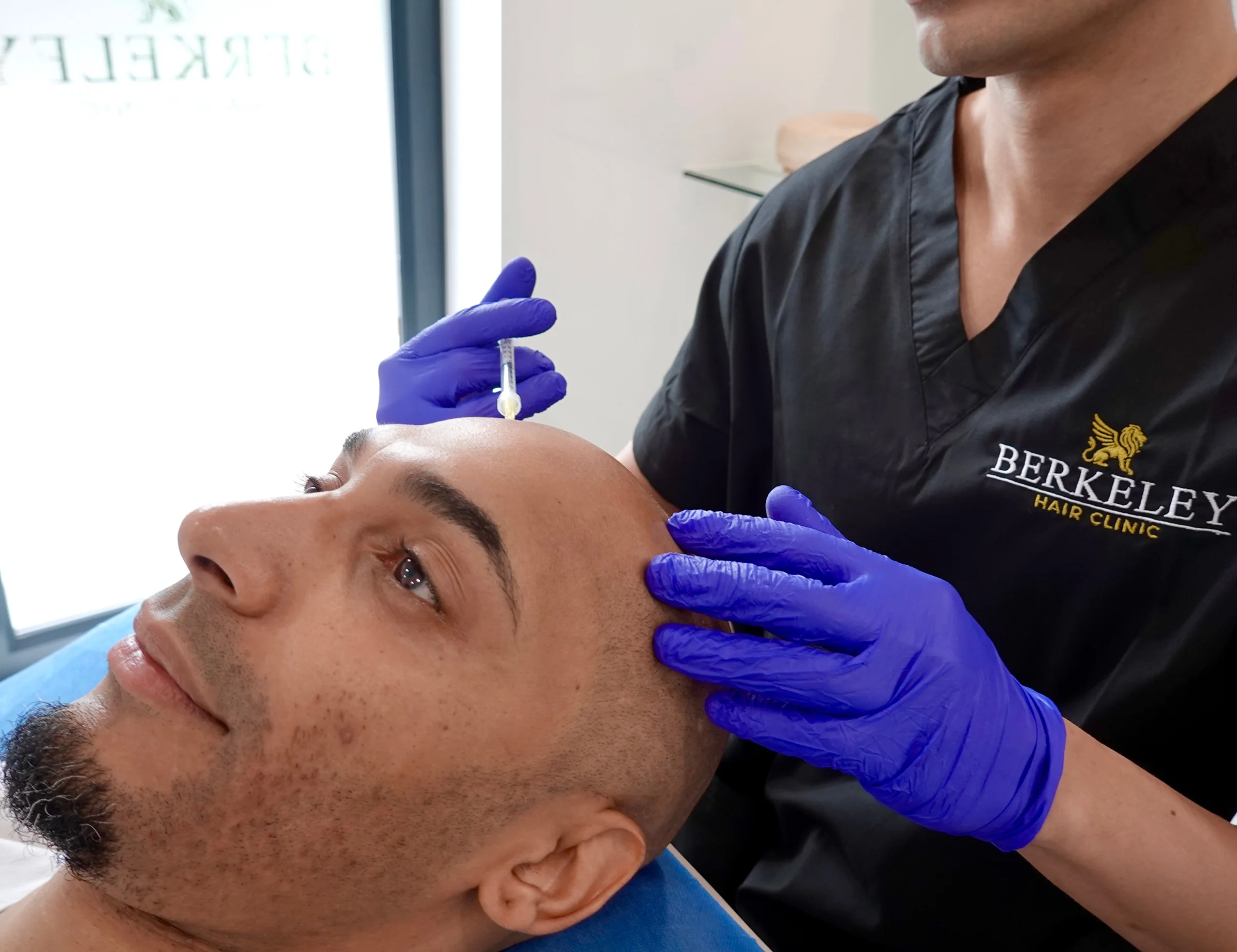 PRP hair restoration at Berkeley Hair Clinic