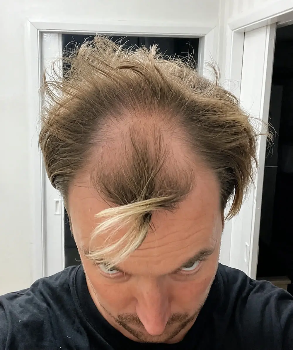 Steve's HairTransplant Review before
