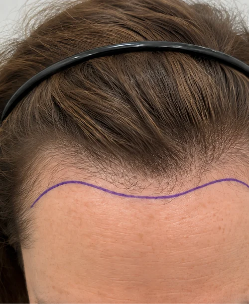 Sarah's Hair Transplant before