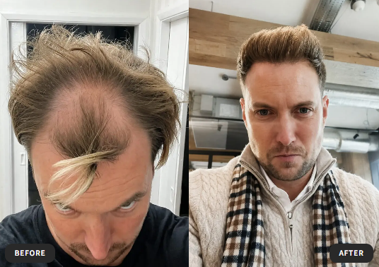 Steve before and after his FUE hair transplant