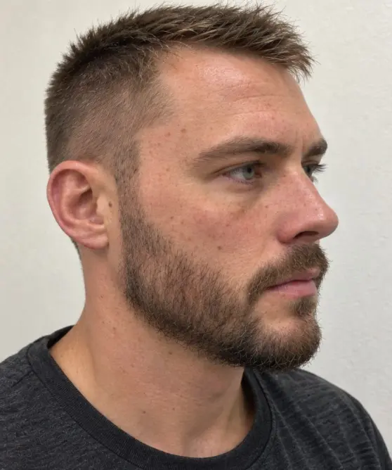 Daniel's Beard Transplant after