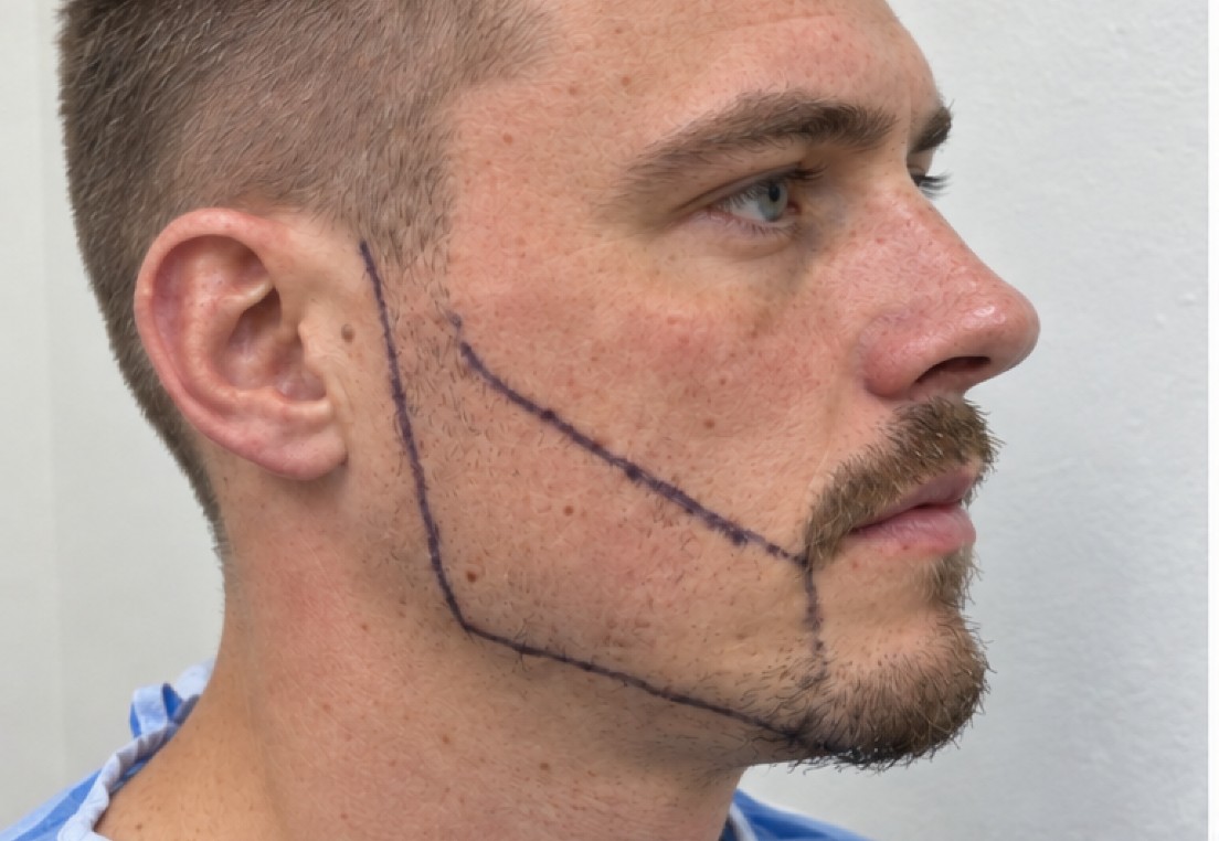 Daniel's Beard Transplant before