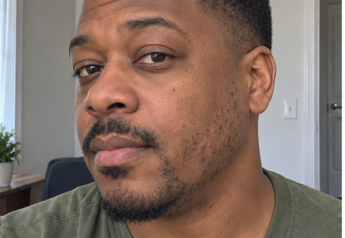 Nathan's Beard Transplant before