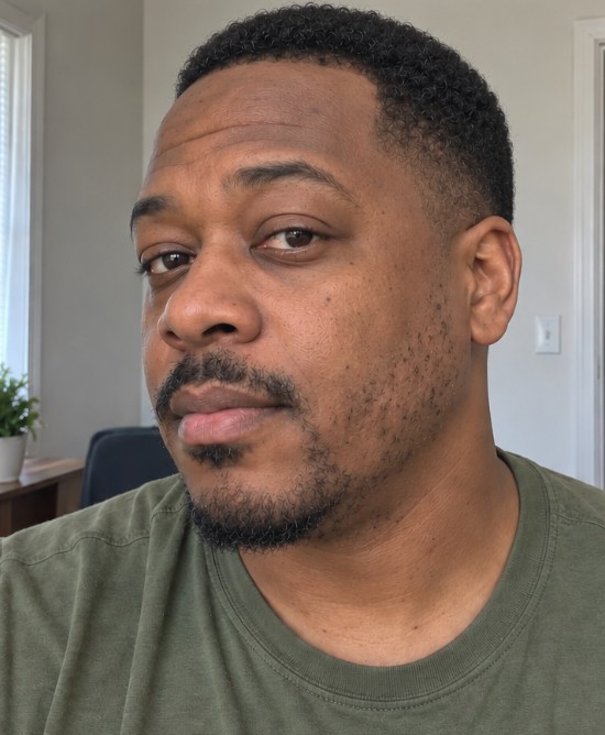 Nathan's Beard Transplant before
