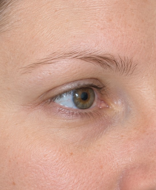 Isabella's Eyebrow Transplant before