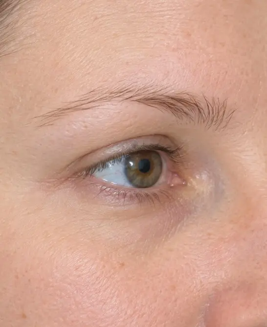 Isabella's Eyebrow Transplant before
