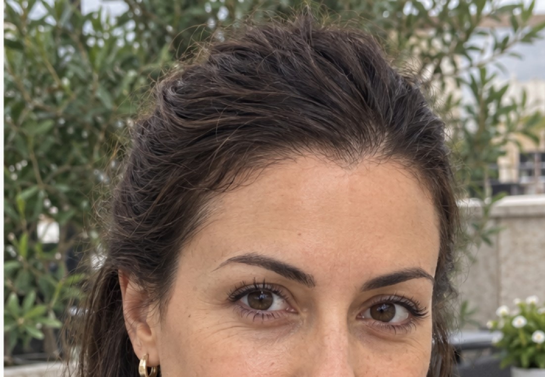 Elena's Hair Transplant after