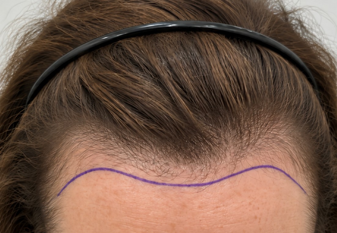 Sarah's Hair Transplant before