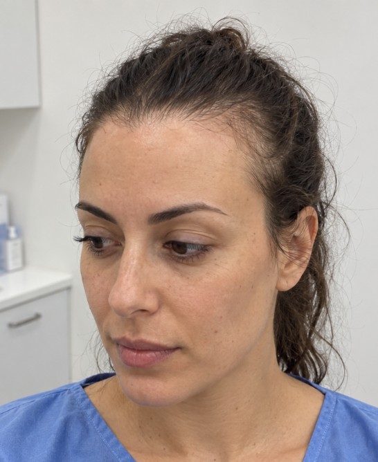 Elena's Hair Transplant before