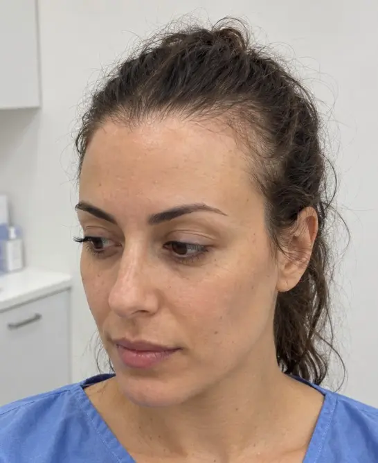 Elena's Hair Transplant before
