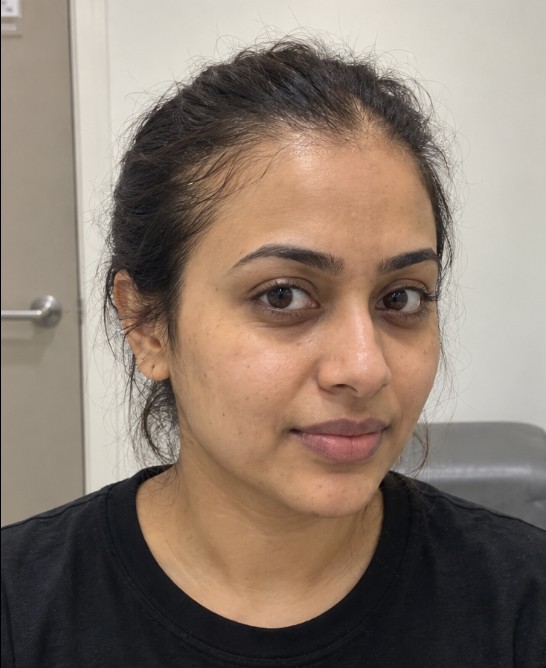 Amanda's Hair Transplant before