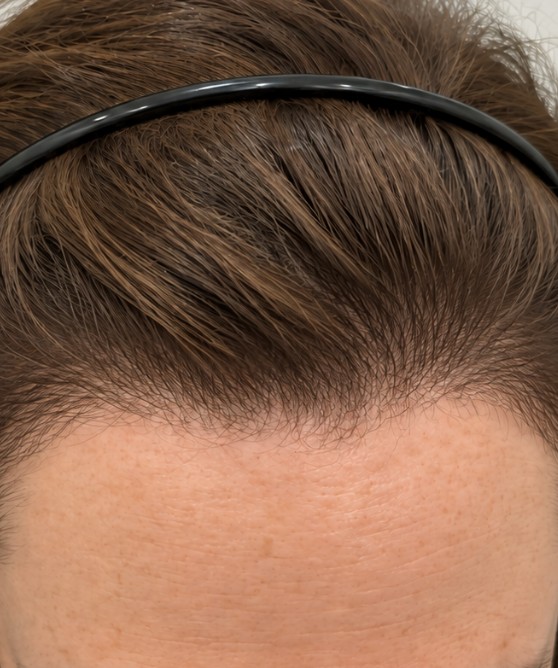 Sarah's Hair Transplant after