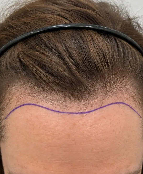 Sarah's Hair Transplant before