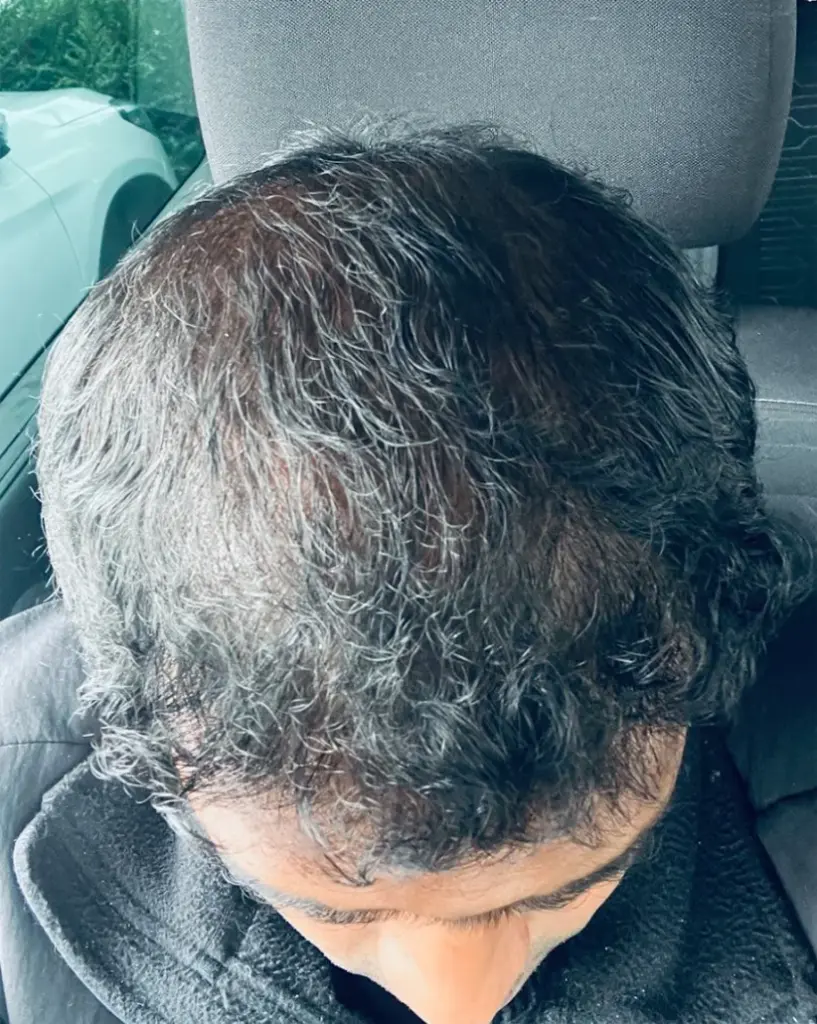 Full Scalp after
