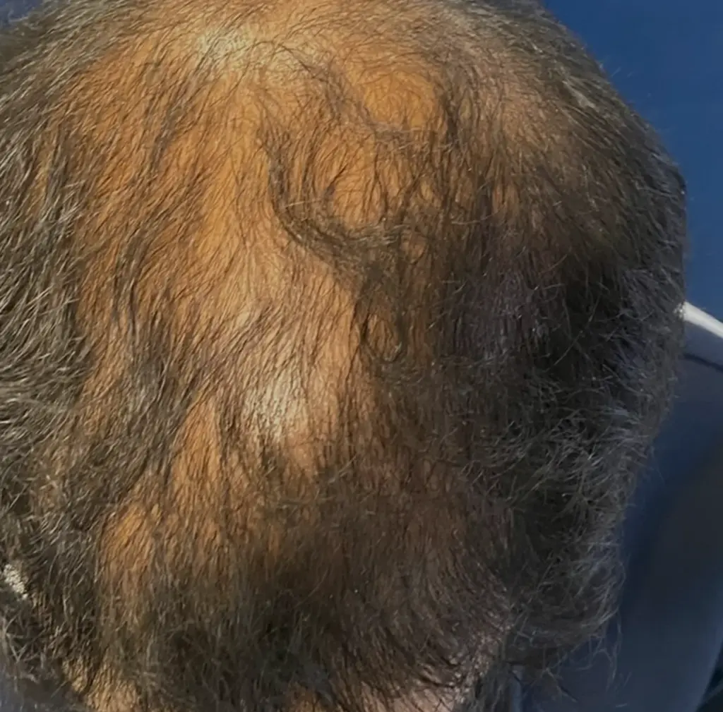 Full Scalp before