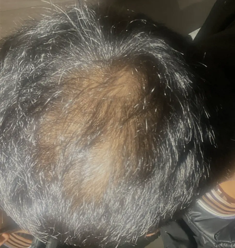 Crown before