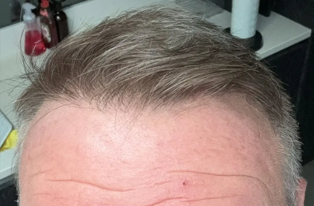 Frontal Hairline after