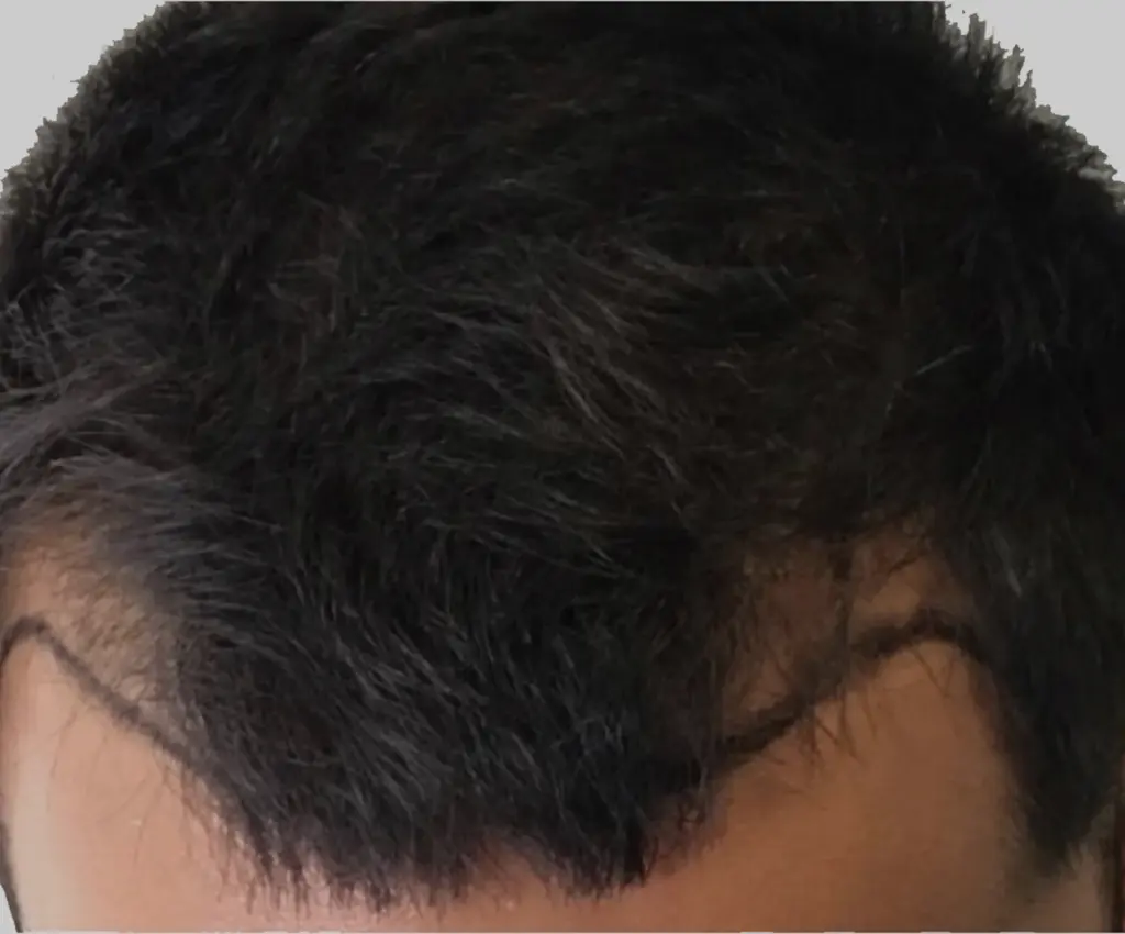 Frontal Hairline before