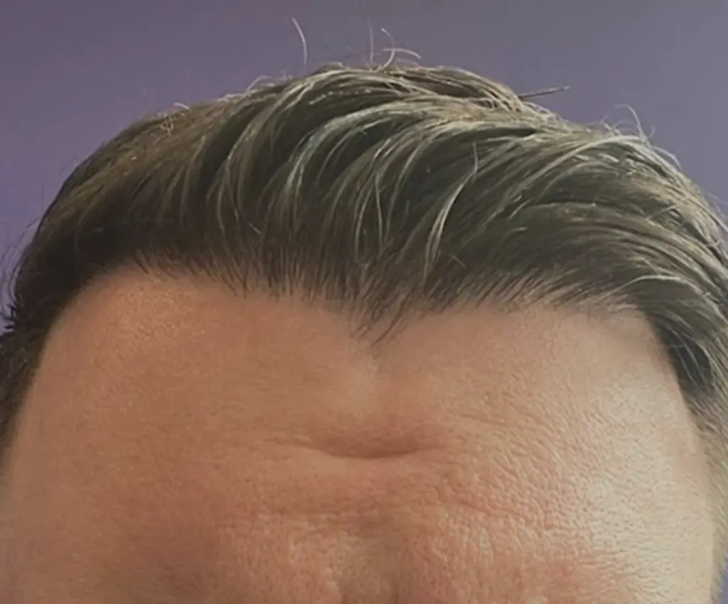 Frontal Hairline after
