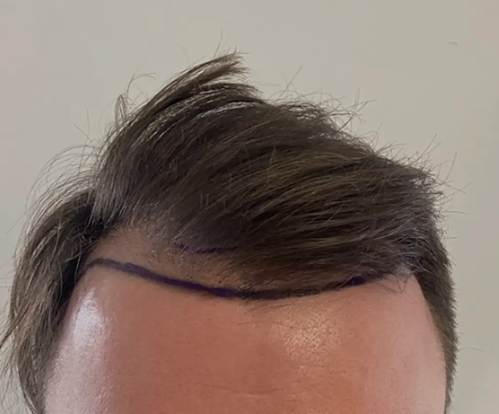 Frontal Hairline before