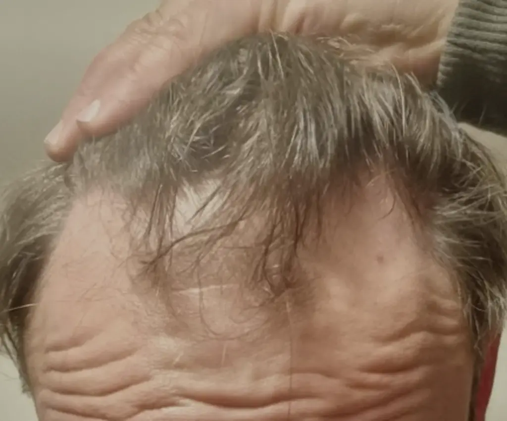 Frontal Hairline before