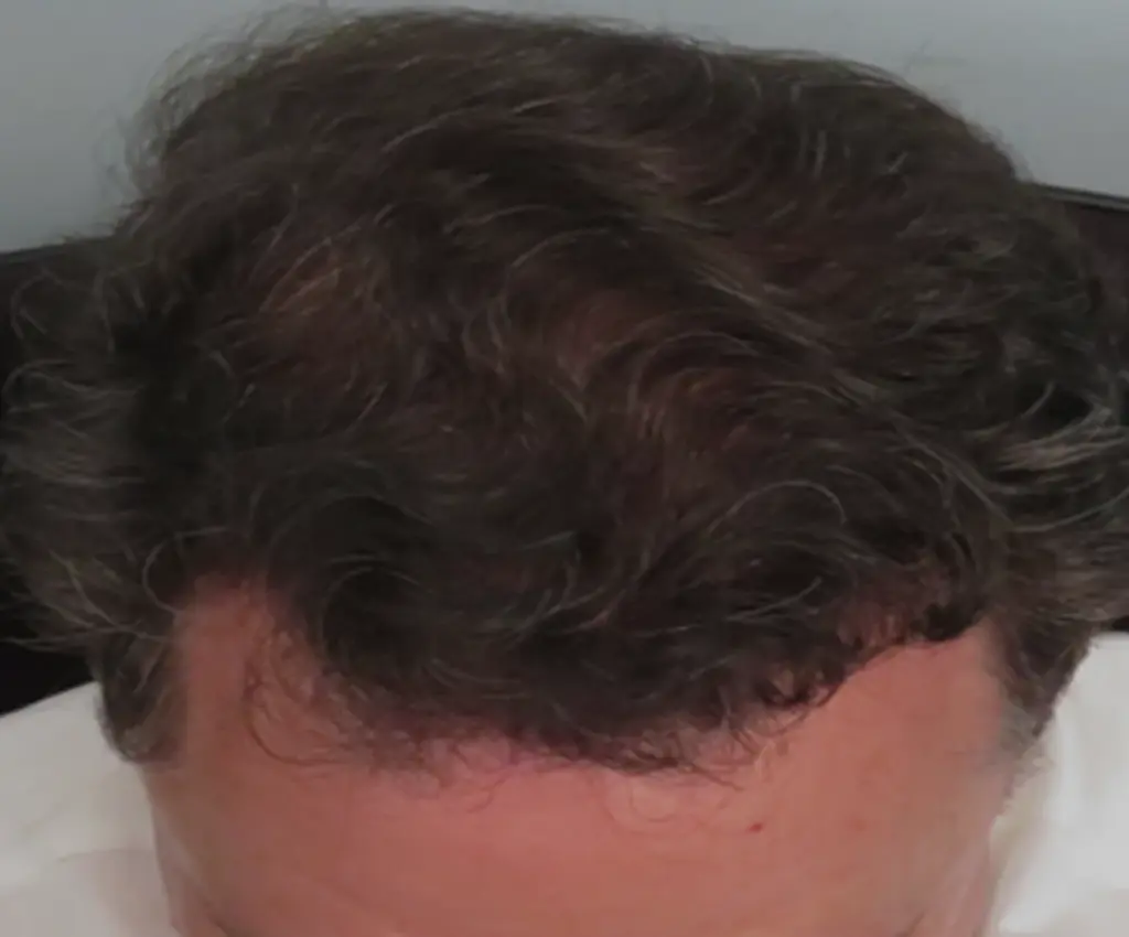 Full Scalp after