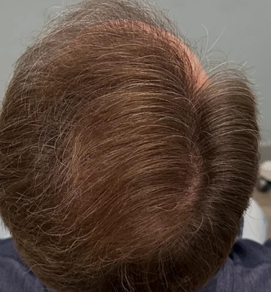 Full Scalp after
