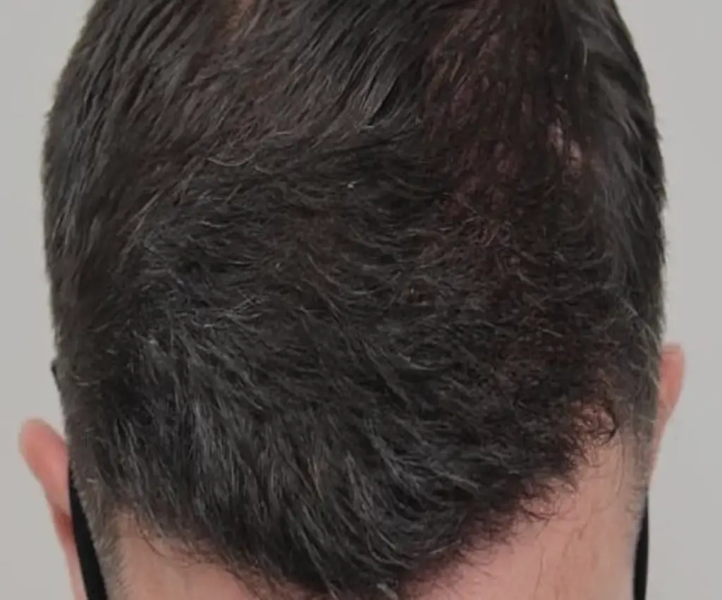 Frontal Hairline after