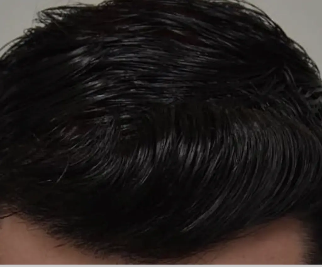 Frontal Hairline after