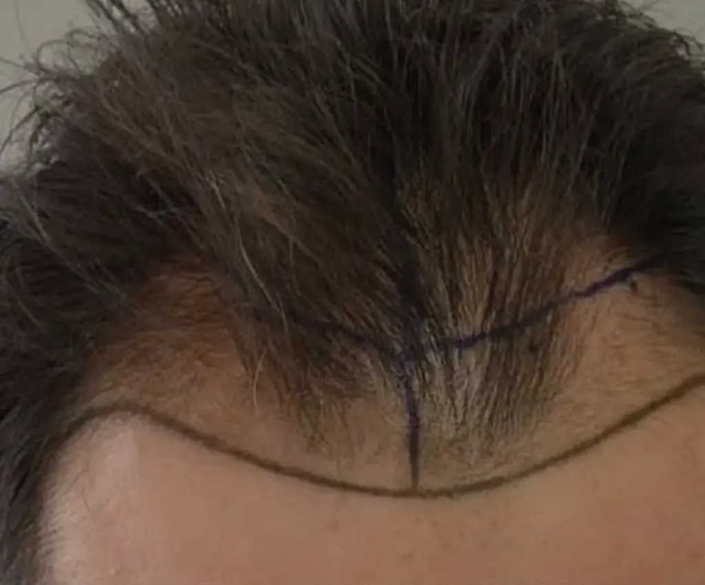 Frontal Hairline before