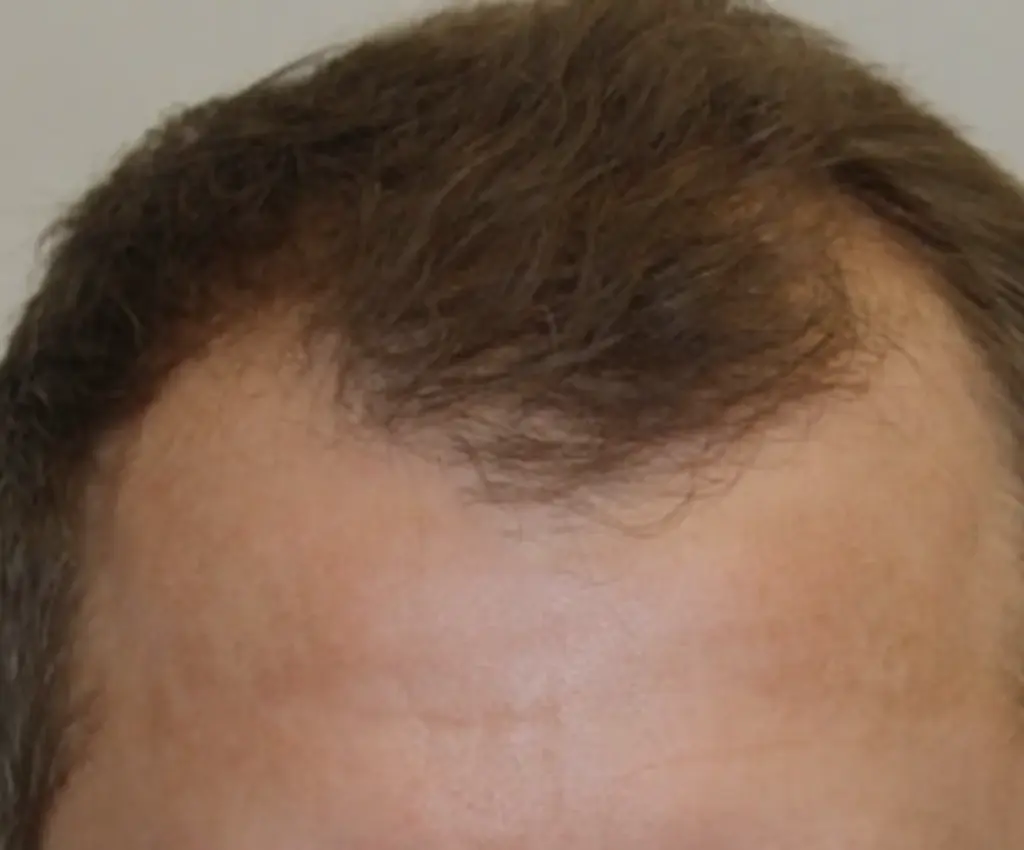 Frontal Hairline before