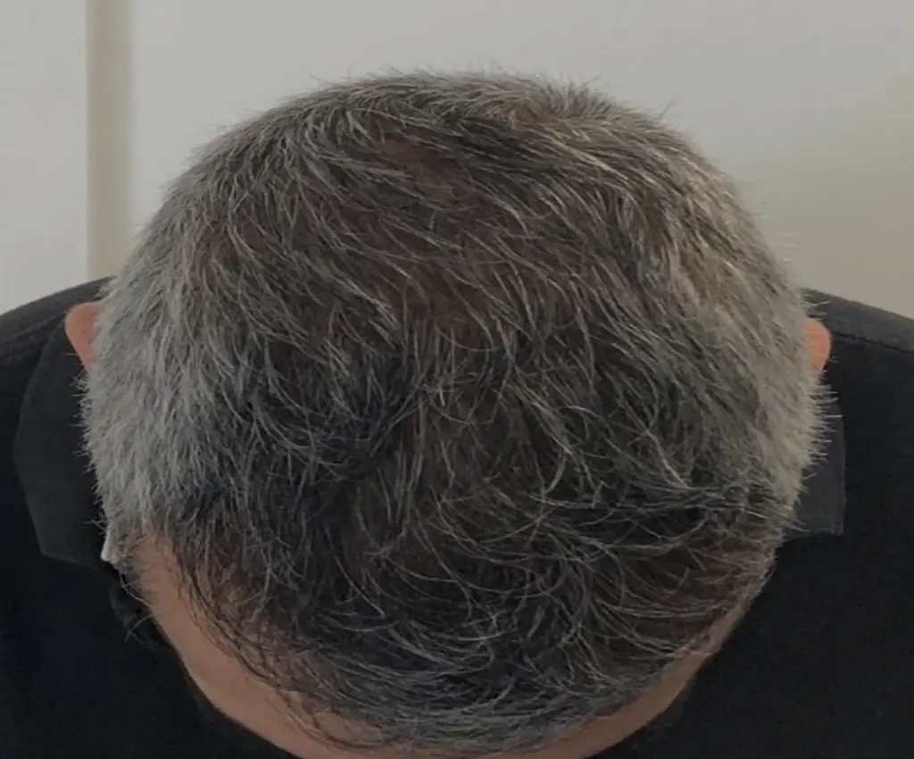 Frontal Hairline after