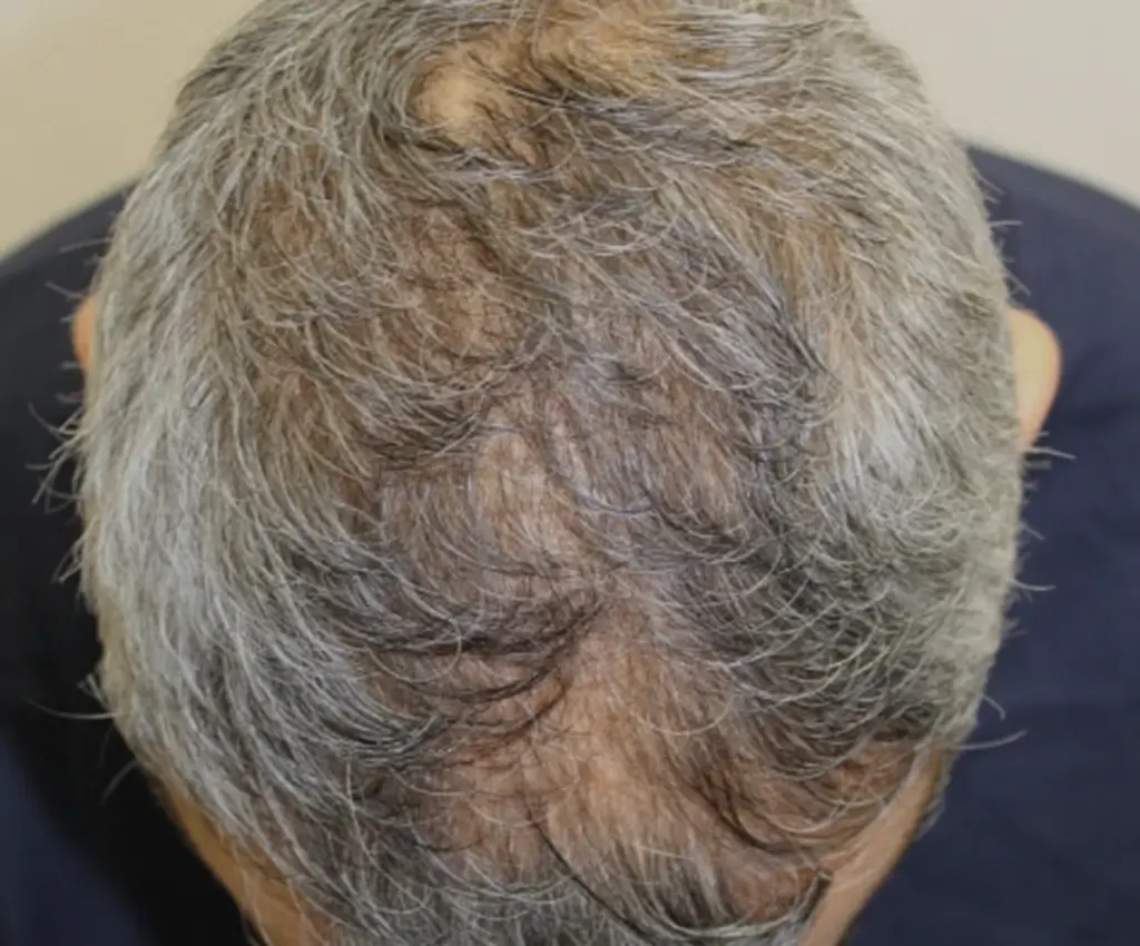 Frontal Hairline before