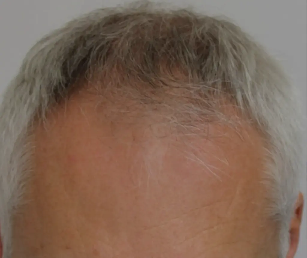 Full Scalp before