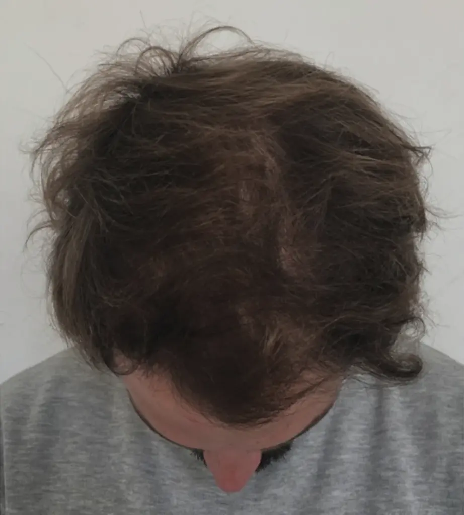 Frontal Hairline after