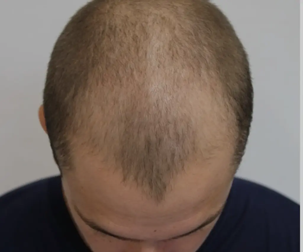 Frontal Hairline before