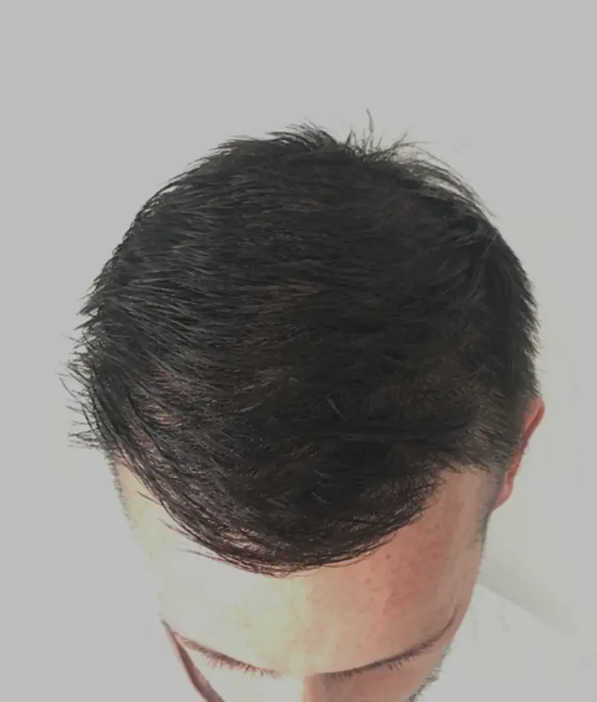 Full Scalp after