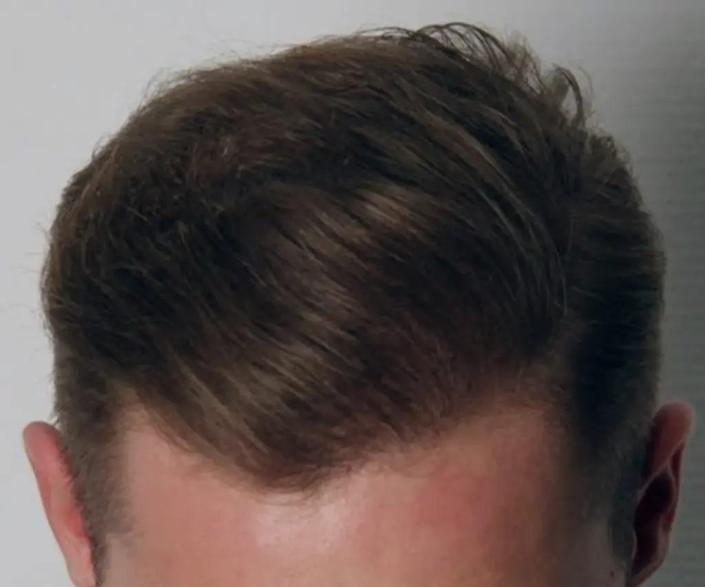 Crown after