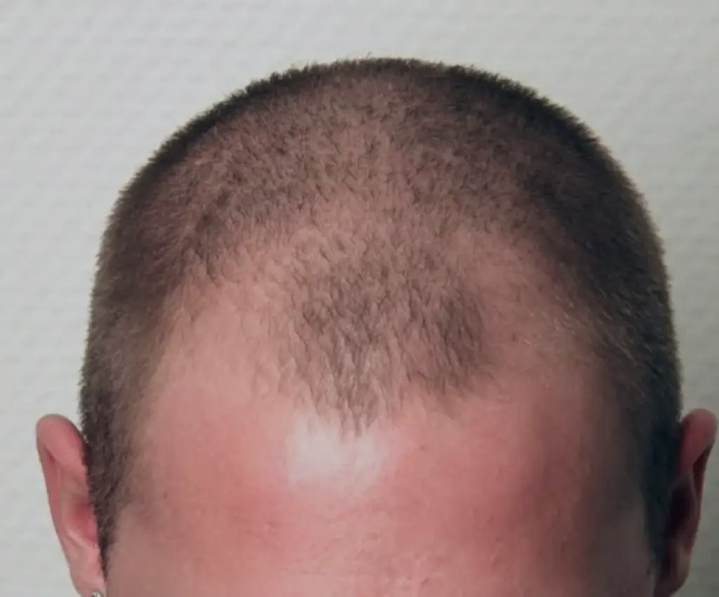 Crown before