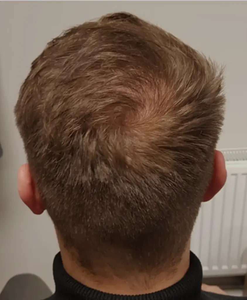 Crown after