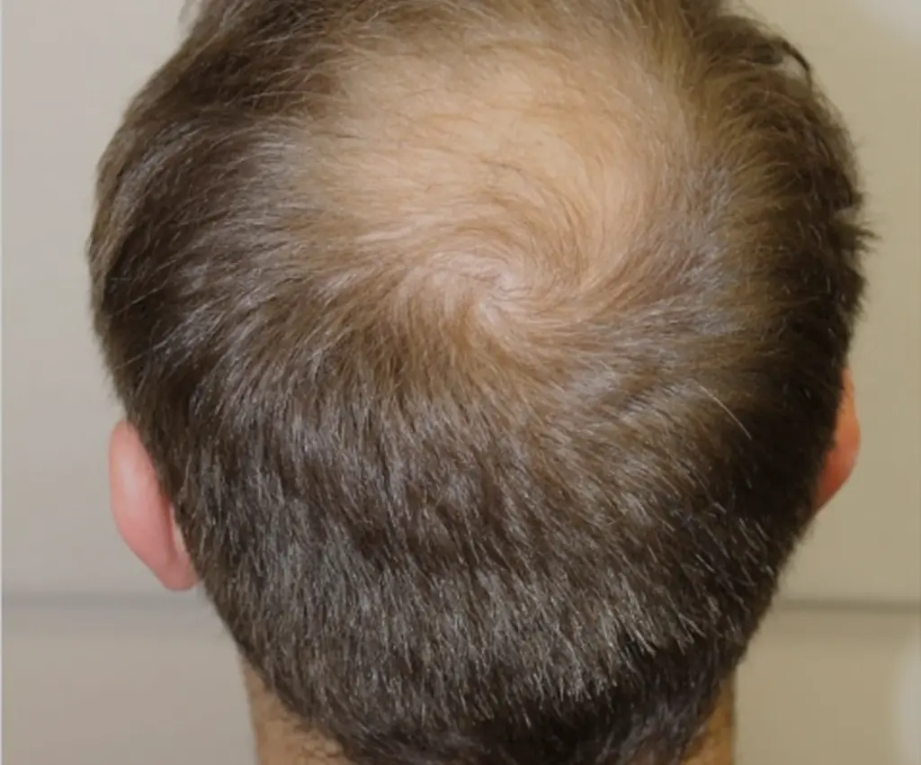 Crown before