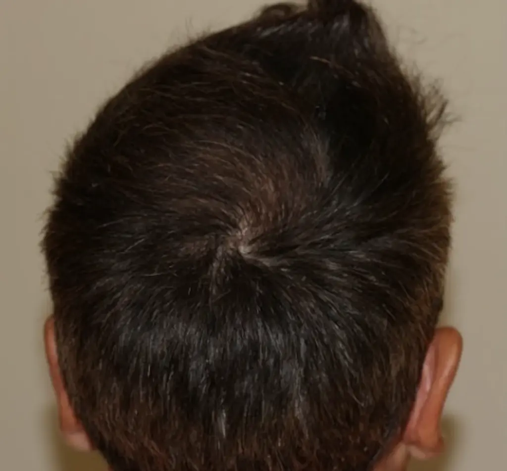 Frontal after