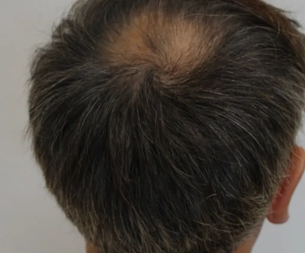 Frontal before