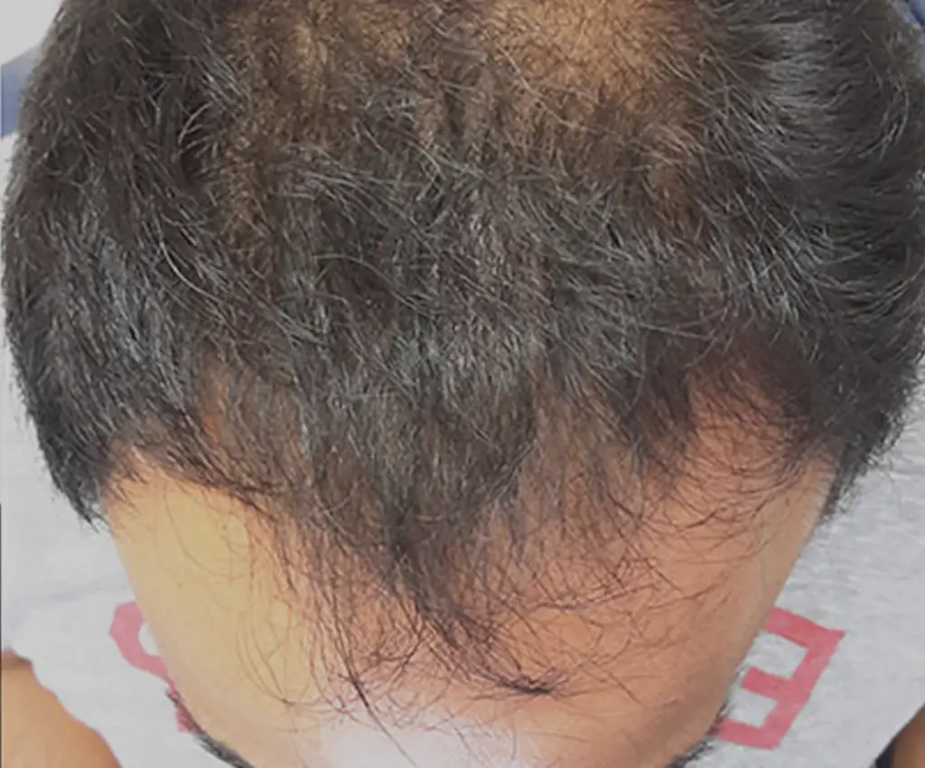 Full Scalp before
