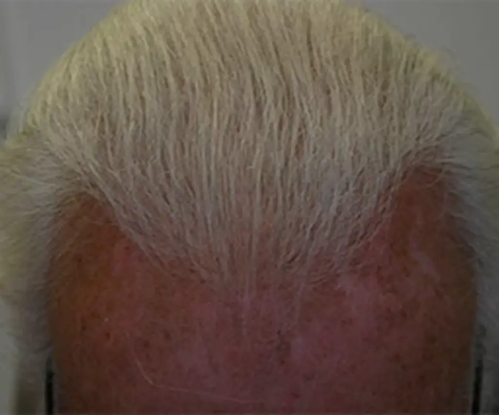 Full Scalp after